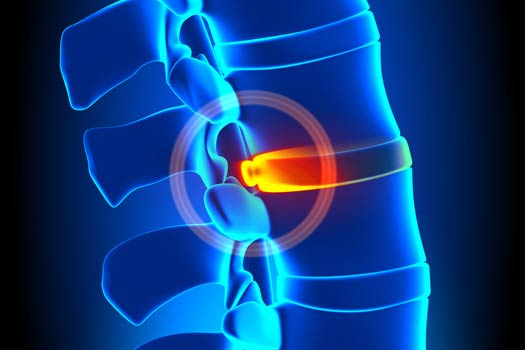 Learn the Difference Between Bulging and Herniated Discs
