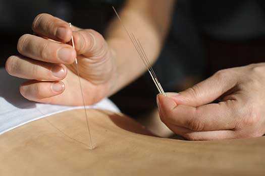 Try Acupuncture Before Spinal Surgery in Santa Monica, CA