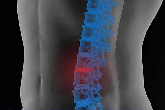 Lumbar Disectomy in Los Angeles, CA.
