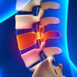 Causes, Symptoms, and Treatments for Spinal Fractures