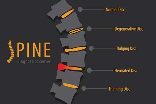 Can Herniated Discs Heal on their Own