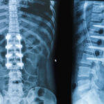 All About Spinal Fusion