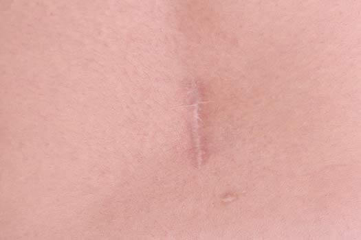 Scar Tissue After Back Surgery