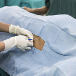 Epidural Injections or Exercise: Which Is Better for Sciatic Pain?