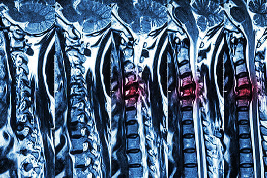 The Signs of Lumbar & Cervical Herniated Discs in Los Angeles, CA
