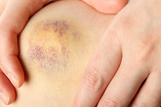 Hematoma on Spine