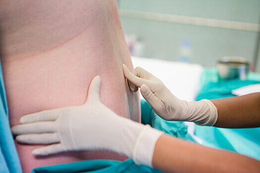 Difference Between Epidural and Spinal