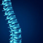 3 Methods for Treating Spinal Cysts