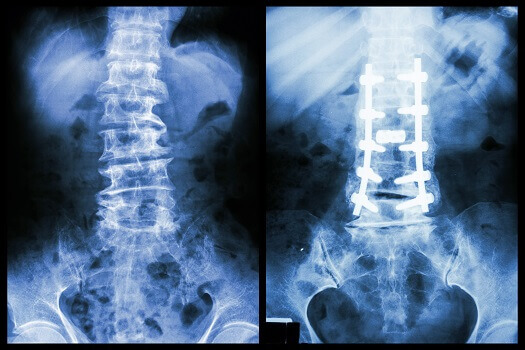 Benefits & Drawbacks of Scoliosis Surgery in Los Angeles, CA