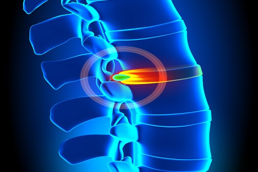 Reasons and Signs of Disc-Related Pain in Los Angeles, CA