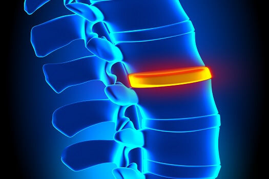 Is Surgery for a Herniated Disc Compulsory in Los Angeles, CA
