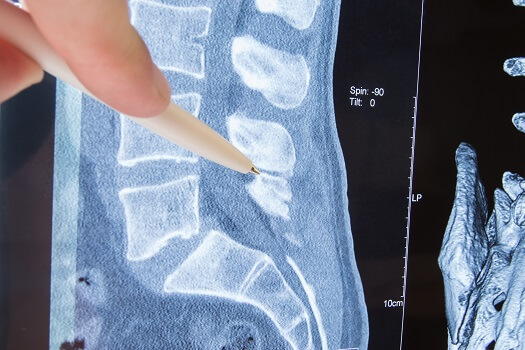 What Are the Results of Not Treating Spinal Stenosis in Los Angeles, CA