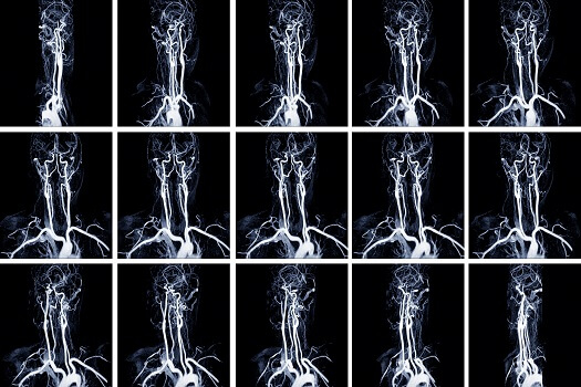 Pros and Cons of Having a Spinal Angiogram in Los Angeles, CA