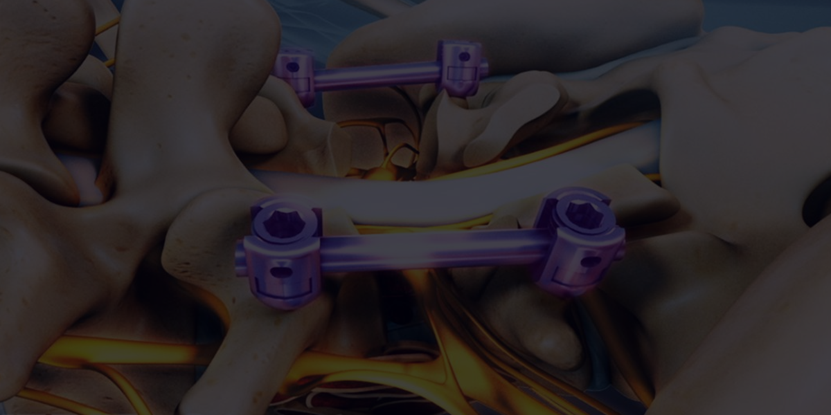 Dynamic Stabilization The Spine Institute CSR