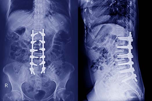 Things Leads to Compression of the Spinal Cord in Los Angeles, CA